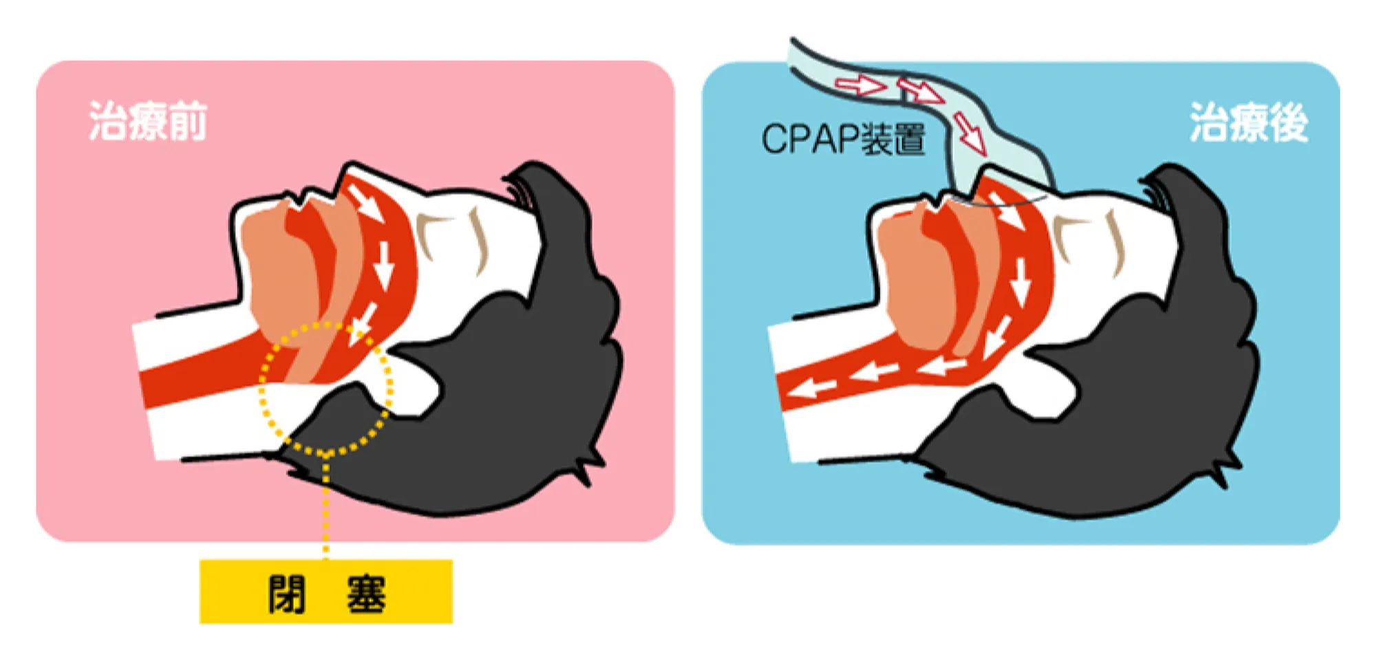 在宅持続陽圧呼吸療法（CPAP療法）のイメージ